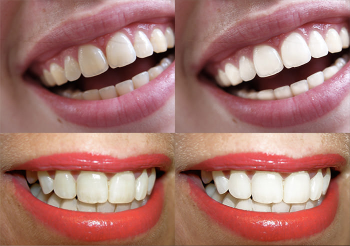 action 056 'Teeth Whitening'